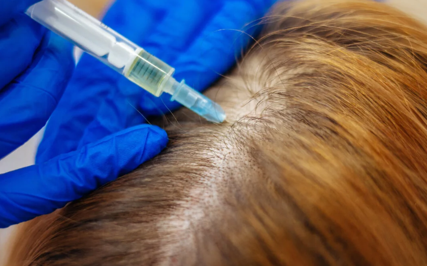 PRP Therapy Hair Loss Treatment in AZ